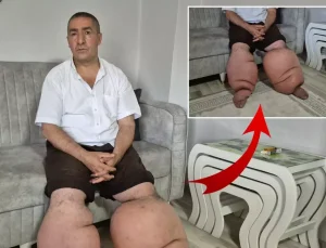 Yüksek ateş şikayetiyle hastaneye gitti, 15 yıldır "fil hastalığı" ile mücadele ediyor