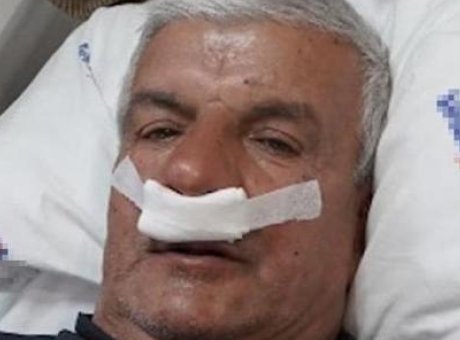 Kariyerinin Sonunda Şok Edici Bir Keşif: 65 Yaşındaki Adamın Burnunda Taş Bulundu!